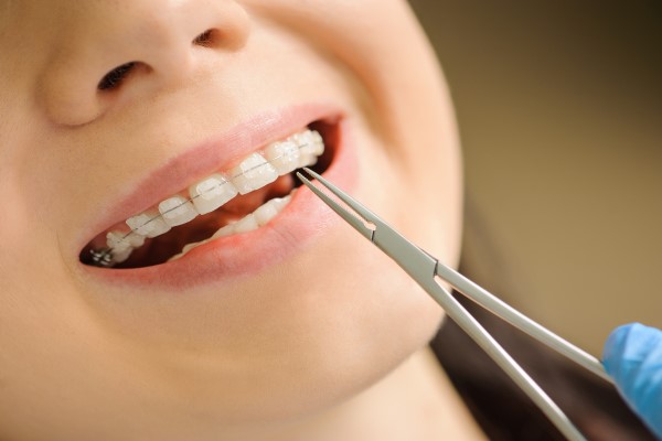 What To Know Before Getting Ceramic Braces
