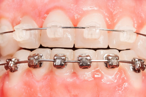 Clear Braces For Adults Are Ideal For Anyone Getting Married