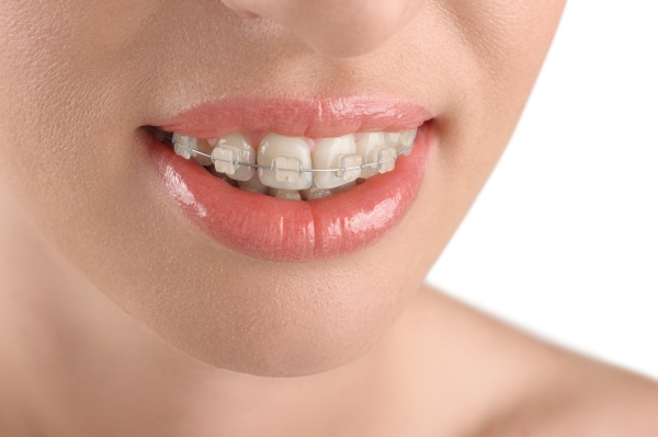 How Are Corrective Braces Different From Aesthetic Braces?