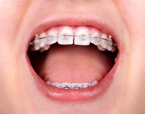 What You Need To Know About Early Orthodontic Treatment