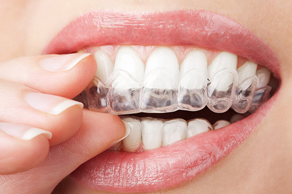 Reasons To Visit An Invisalign Orthodontist