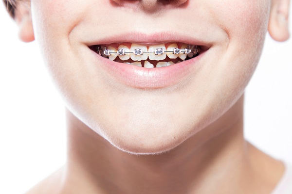 How Does Orthodontic Treatment Work?